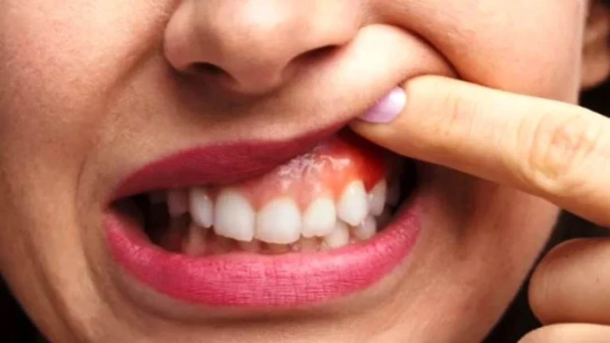 7 Cara Perawatan Radang Gusi (Gingivitis Treatment) di Rumah