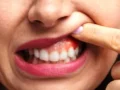 7 Cara Perawatan Radang Gusi (Gingivitis Treatment) di Rumah