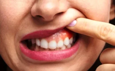7 Cara Perawatan Radang Gusi (Gingivitis Treatment) di Rumah